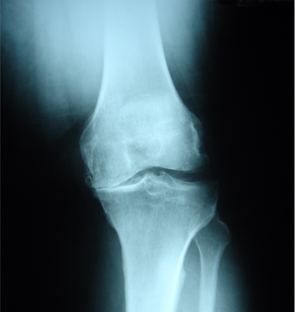 exercise and osteoarthritis of the knee