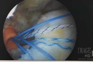 Rotator Cuff Repair Louisville