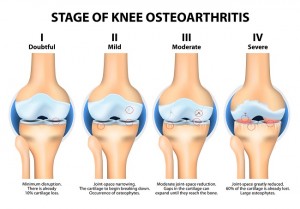 10 facts about osteoarthritis