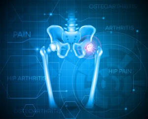 complications after total hip replacement