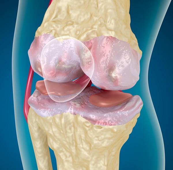 What is osteoarthritis from orthopedic surgeon
