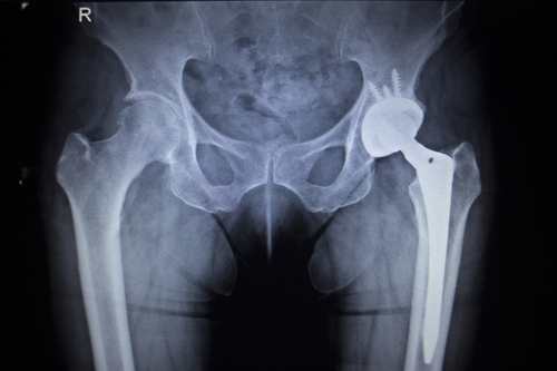 Total Hip and Knee Replacement Surgery