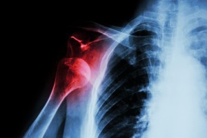 Shoulder Dislocation Research News