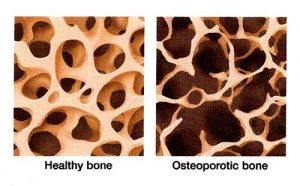 Bone Health and Osteoporosis