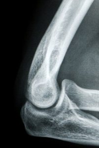 ulna collateral ligament injuries