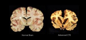 CTE caused by concussions