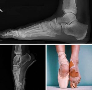What does a ballerina's look like on an X-ray? Orthopaedic Specialists