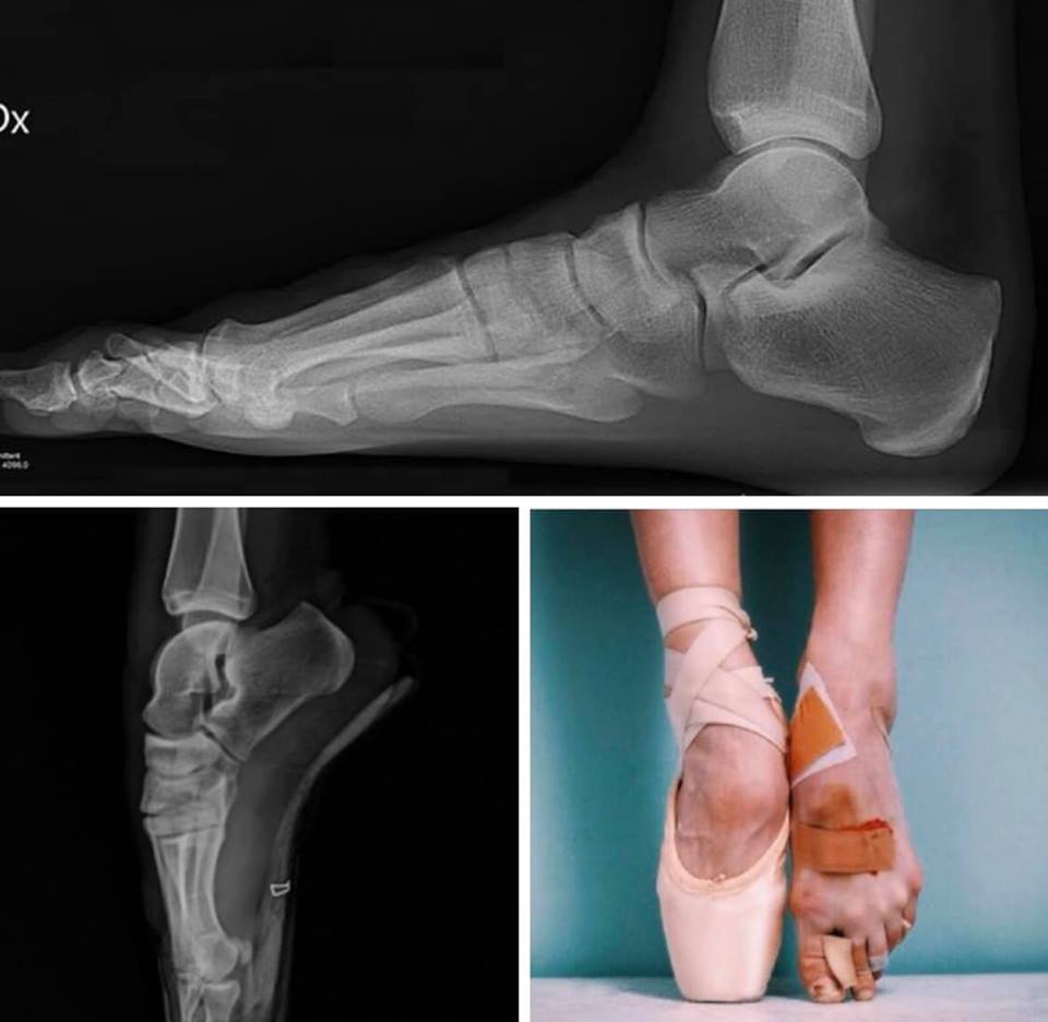 Ballerina feet xray