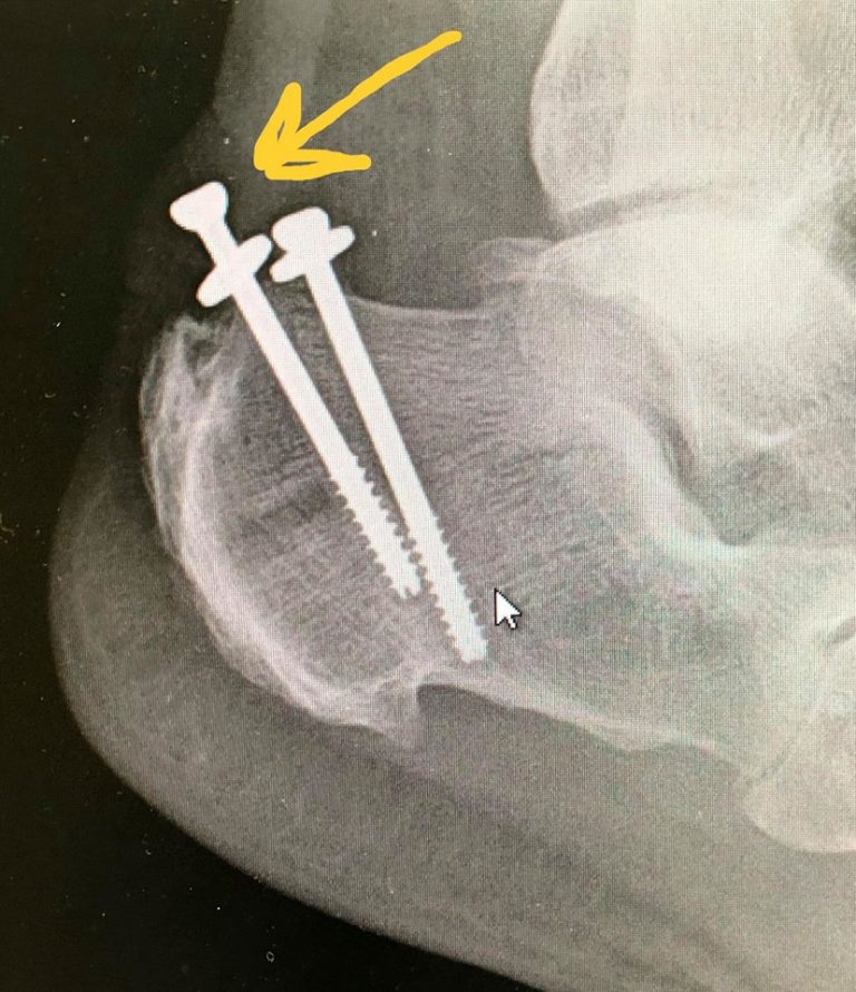 When a Screw Comes Loose The Orthopaedic Specialists of Louisville