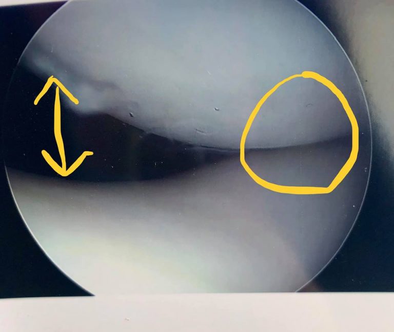 icd 10 code for right knee lateral patellar compression syndrome