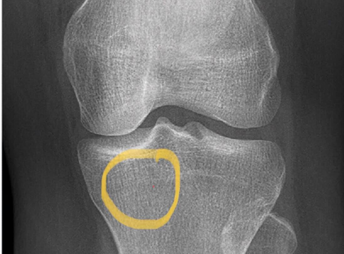 Do Fractures & Broken Bones Show up on X-rays? Orthopaedic Specialists