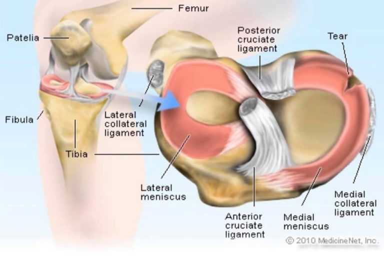 Five Signs You Have Torn Your Meniscus Louisville Bones Hot Sex Picture