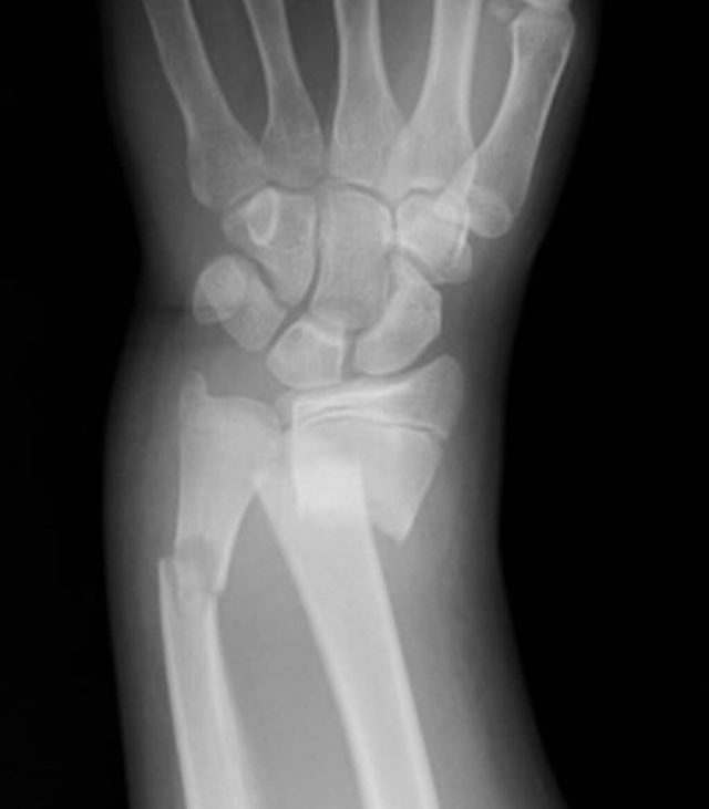 How Long Does A Broken Bone Take To Heal? - Orthopeadic Specialists