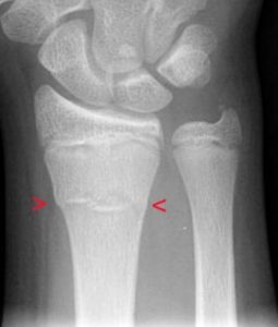 How Long Does A Broken Bone Take To Heal? - Orthopeadic Specialists