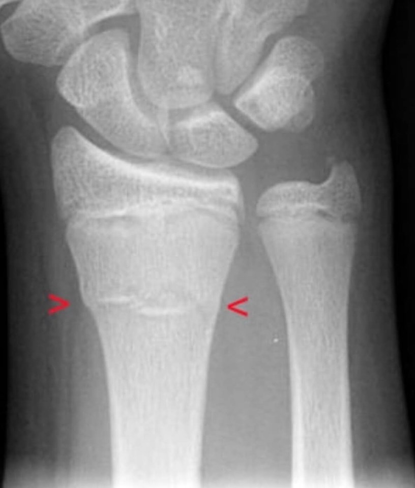 Signs a Broken Bone Is Healing - Foot and Ankle Podiatrists