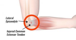 tennis elbow facts