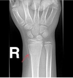 Distal radius fracture buckle fracture