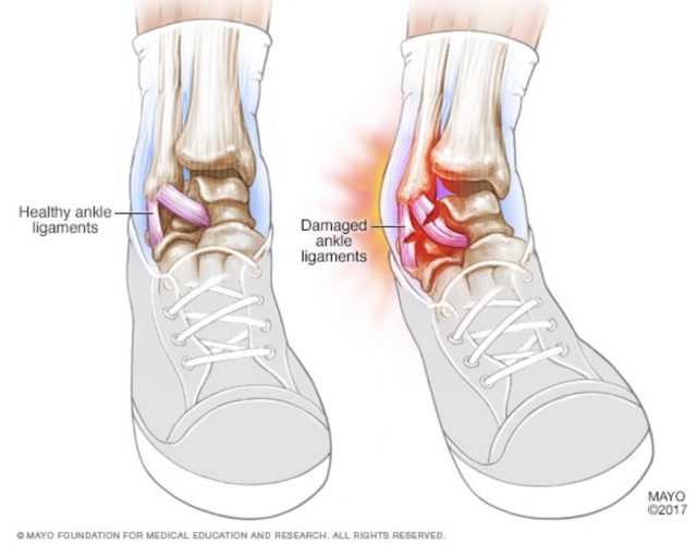 Ankle Sprain Treatment Helps Early Recovery - Louisville Bones