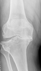 The image shows and arthritic knee. The image is to educate what an arthritic knee looks like on Xray