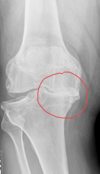 To educate what an arthritis knee xray look like and the detail of bone on bone