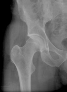 To educate what a normal hip without arthritis looks like on xray