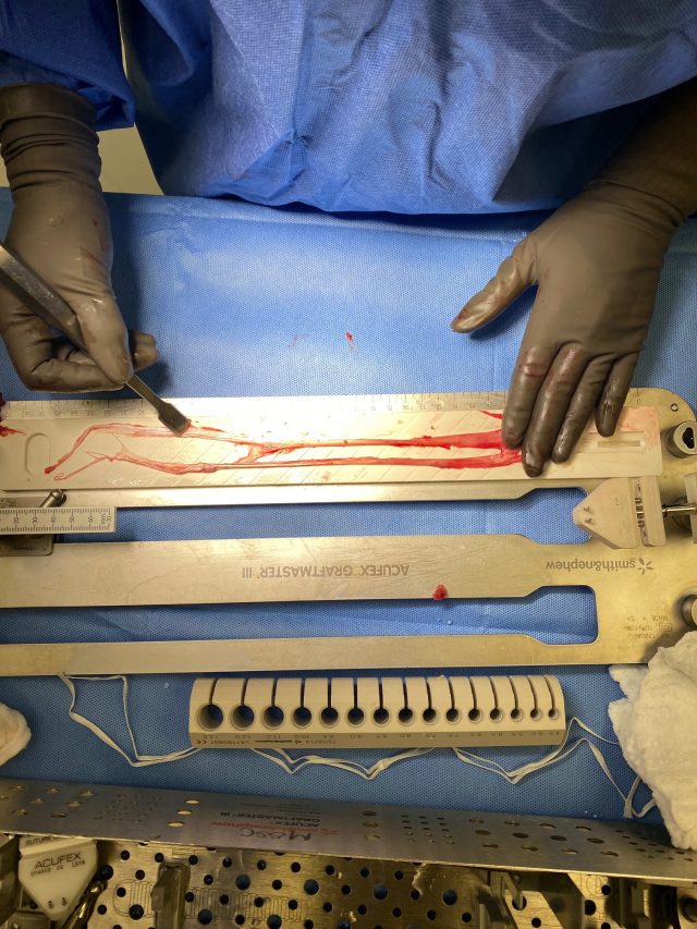 ACL Treated with Hamstring Graft Louisville Bones