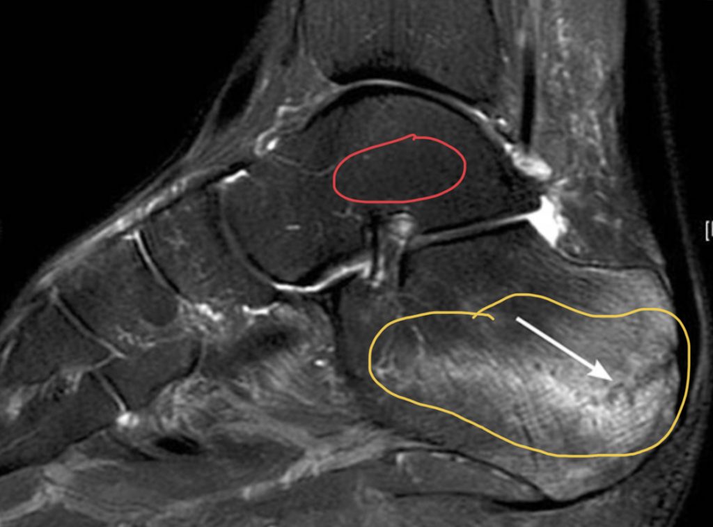 Broken Bone Versus Fracture What Is The Difference Louisville Bones   BE2B5E0C C58E 4661 A8DF 23E66568699C 1024x757 