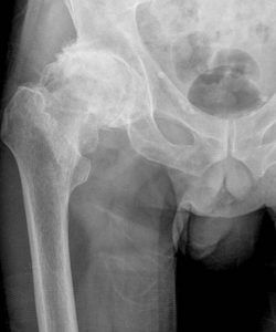 To educate what an arthritic hip looks like on xray
