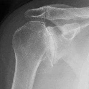 To educate what an arthritic shoulder looks like on xray