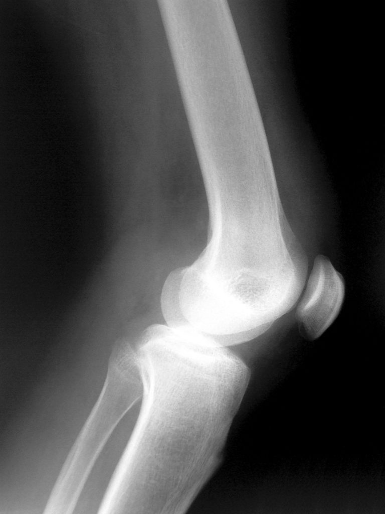 Knee X Ray Patellar Tendinitis Jumpers Knee Louisville Orthopaedic