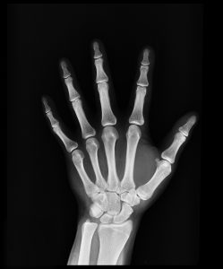 De Quervain's Syndrome, Hand Pain, Orthopedic Doctor