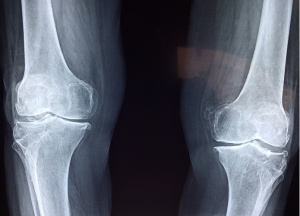 Considering a knee replacement in Louisville? Learn more here