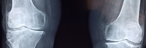 Considering a knee replacement in Louisville? Learn more here