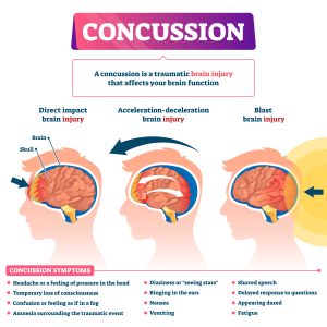What is a concussion?