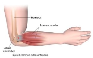 Bess Fley, P.A., at Orthopaedic Specialists in Louisville, KY treats a variety of different injuries, including tennis elbow.