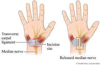 A step-by-step guide on carpal tunnel release surgery with Dr. Grossfeld.