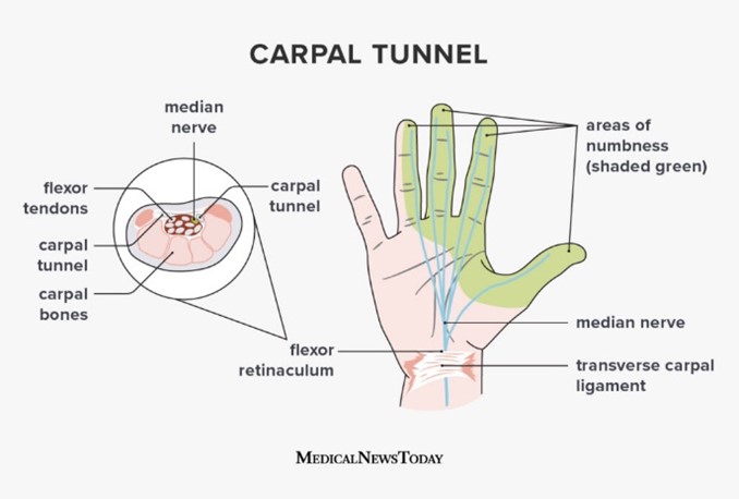 An overview of Carpal Tunnel Release Surgery with Dr. Grossfeld.