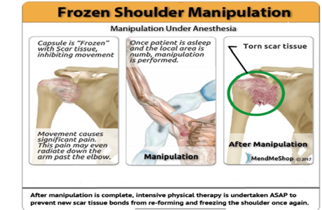 An overview of closed manipulation of the shoulder from Louisville orthopedic surgeon Dr. Stacie Grossfeld.