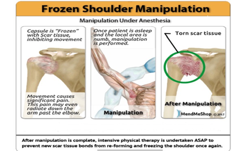 Patient Education Closed Manipulation of the Shoulder