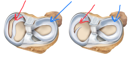 Torn Meniscus - Repair and Post Op Instructions - Connecticut