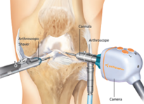 What happens before, during, and after meniscal tear surgery with Dr. Grossfeld.