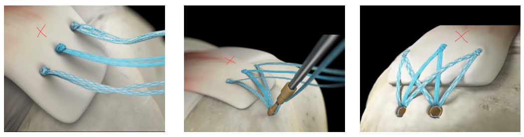 An overview of rotator cuff surgery when you schedule with Dr. Stacie Grossfeld of Louisville, KY.