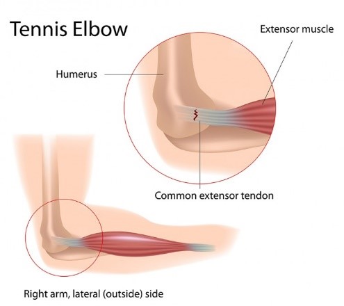 A step-by-step guide of the tennis elbow repair surgery with Dr. Grossfeld in Louisville, KY.