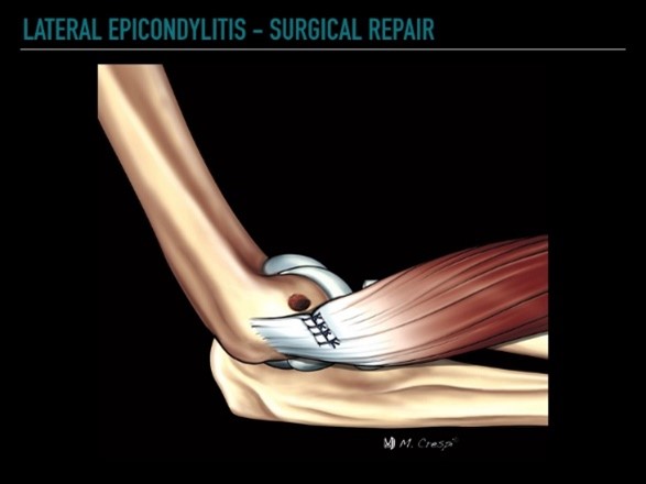 An overview to tennis elbow repair surgery with Dr. Grossfeld.