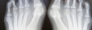 X-ray of bunions on big toe, Louisville Orthopedic Specialist for bunions treatment