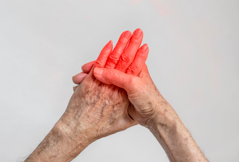 Treatment Options for Palindromic Rheumatism