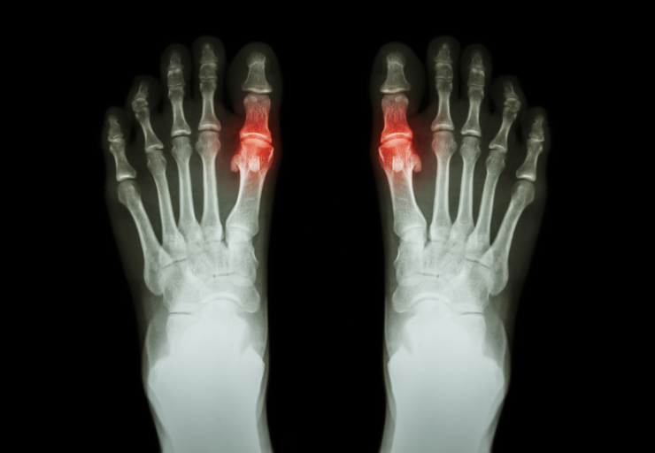 Gout and Pseudogout treatment in Louisville KY