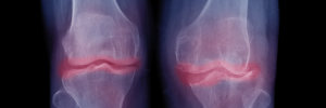 Extreme osteoarthritis