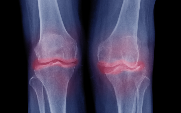 Extreme osteoarthritis