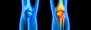 Knee Arthritis Treatment